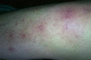 大腿内侧出现红斑瘙痒症状有红斑是为什么_第二人生