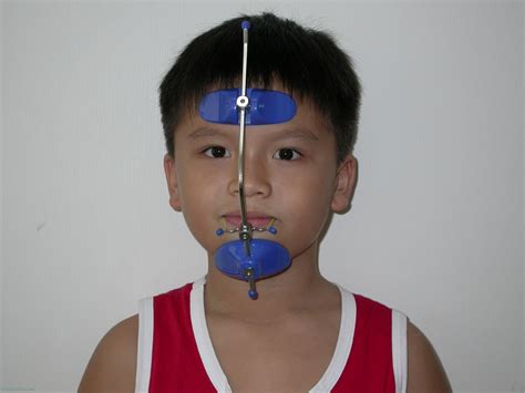 Orthodontic Treatment | Yap & Associates Dental Surgery, Kuala Lumpur, Malaysia - Part 2