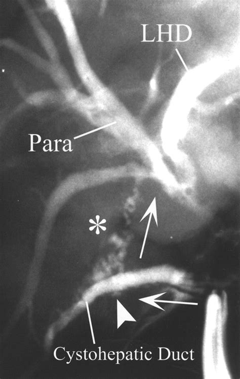 Bile Duct of Luschka Connecting with the Cystohepatic Duct: The ...