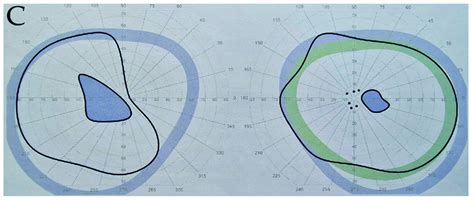 Image result for Visual Field Screen