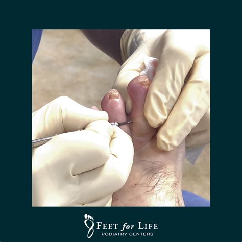 Mini-Invasive Flexor and Extensor Tenotomy Hammertoe Mallet Toe