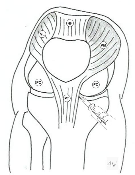 Image result for Ankle Anterolateral Approach Injection