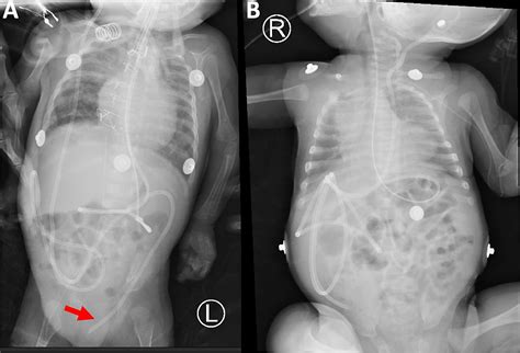 The “SHIFT” technique: Suprahepatic IntraFalciform tubing for placement ...