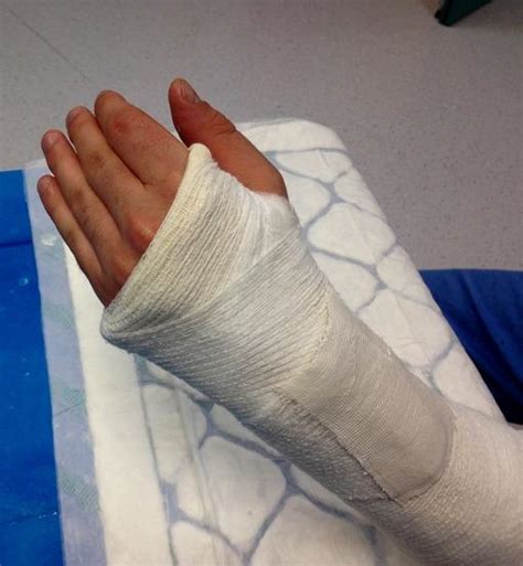 Hand Plaster 的图像结果