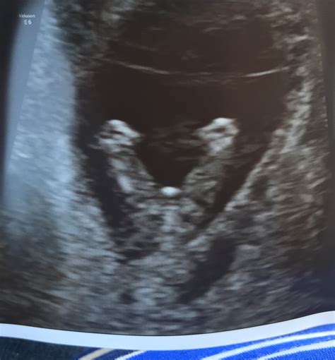 Ultrasound Of Fetus At 14 Weeks