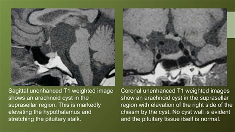 Pituitary gland MRI | PPTX