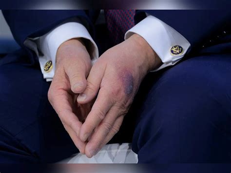 Trump explains his large hand bruise as questions grow over his health ...
