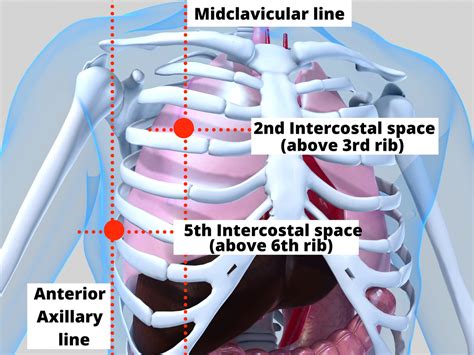 Image result for Locating Needle Decompression Site Using Open Hand as Guide