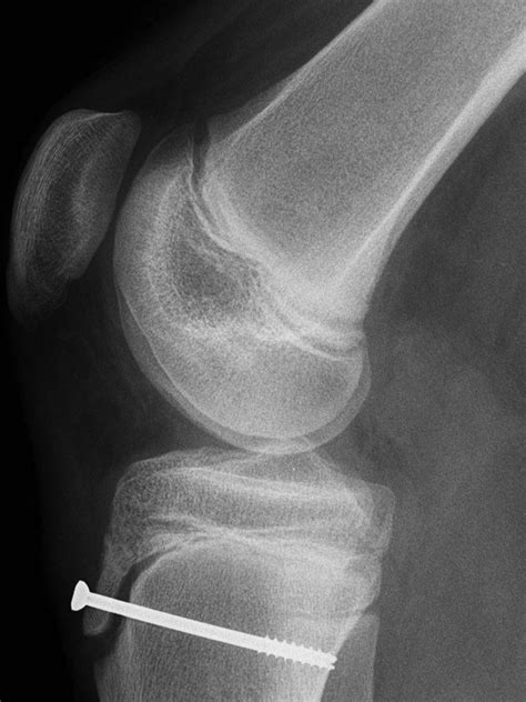 Complete resolution of the symptoms of refractory Osgood-Schlatter disease following ...