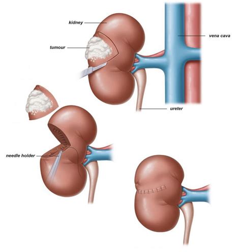 Image result for Robotic Partial Nephrectomy Video Animation