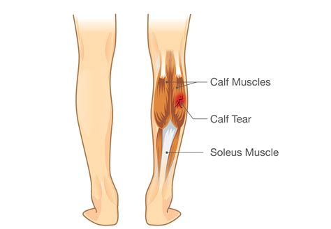 Calf Pain: Plantaris Tendon Rupture