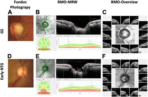 Representative cases of GS and early NTG. (A) The optic disc of a ...
