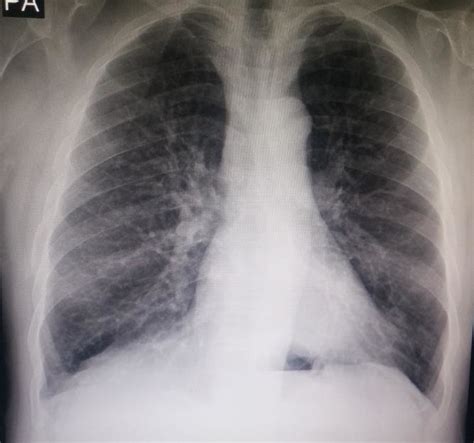 Hospital X-ray Chest 的图像结果