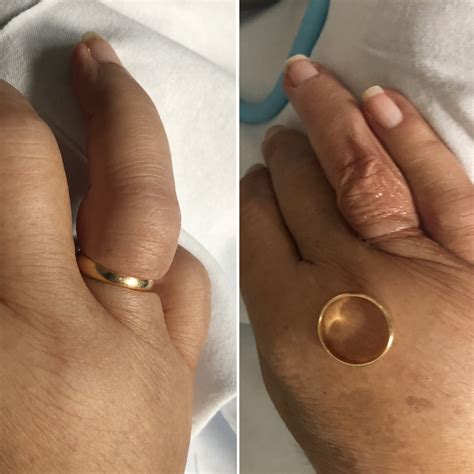 Image result for Remove Stuck Compression Ring