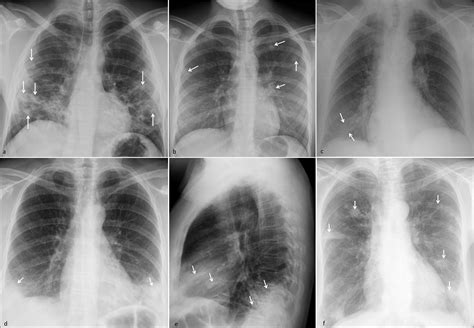 Schematic approach to the diagnosis of multifocal lung opacities in the ...