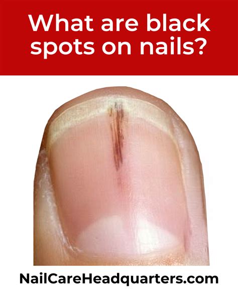 Albums 103+ Pictures Photos Of Toe Nail Melanoma Updated