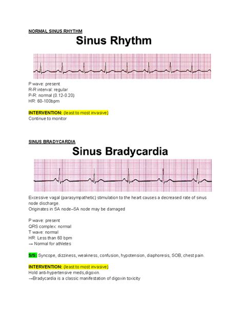 EKGs - EKG information - NORMAL SINUS RHYTHM P wave: present R-R ...