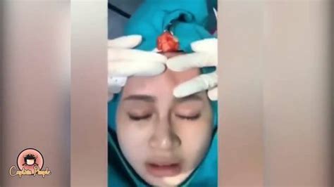 Exploding Cysts Compilation 的图像结果