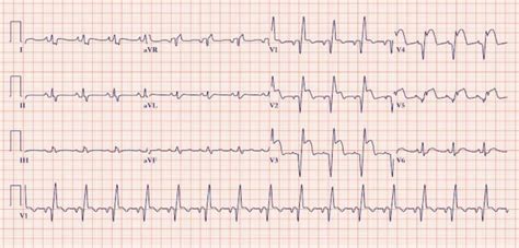 Management of a patient with myocardial infarction . | Freelancer