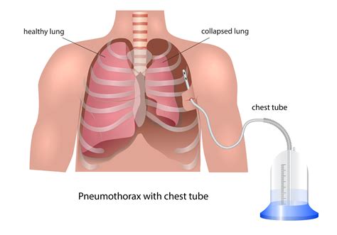 Treatment For Collapsed Lung Pneumothorax