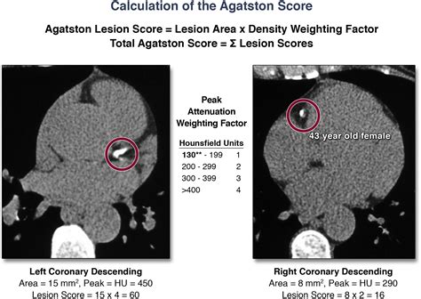Coronary Artery Calcium Scoring: Is It Time for a Change in Methodology? | JACC: Cardiovascular ...