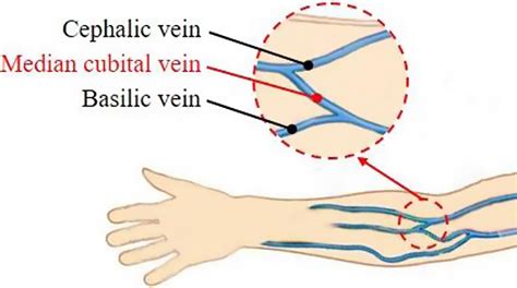 A trocar puncture robot for assisting venipuncture blood collection ...