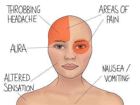 Migraine Prevention - Gemini Osteopathy