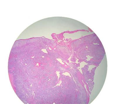 Case 1111 - Man in his 50s with Periodic Sweating and Diarrhea | Department of Pathology