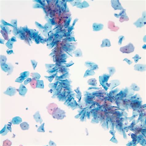 Fig. 2.55 Negative for intraepithelial lesion or malignancy (NILM). Fungal organisms ...