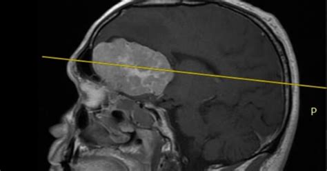 Descubren el origen del tumor cerebral más frecuente en casos de ...