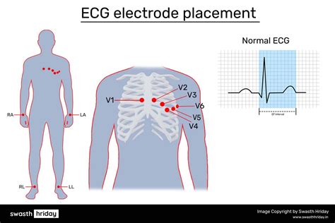 Will Heart Disease Show Up on an ECG? | Diagnosing Arrhythmias and ...