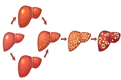 Liver Cancer Treatment in Lucknow | Dr. Srivastava