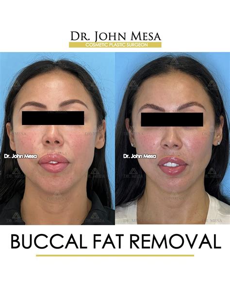Buccal Fat Pad Dental Code at Rosie Halsey blog
