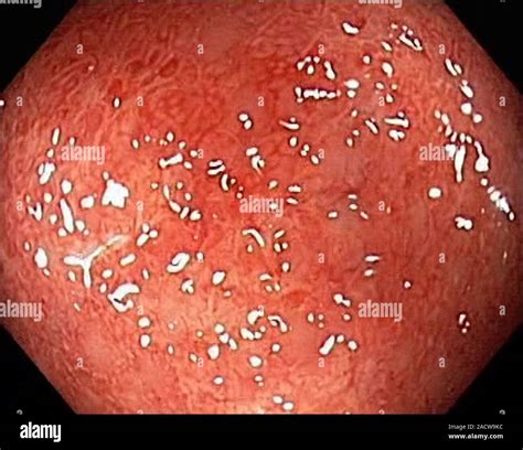 Infectious colitis, endoscope view. Inflammation of the intestines in a ...