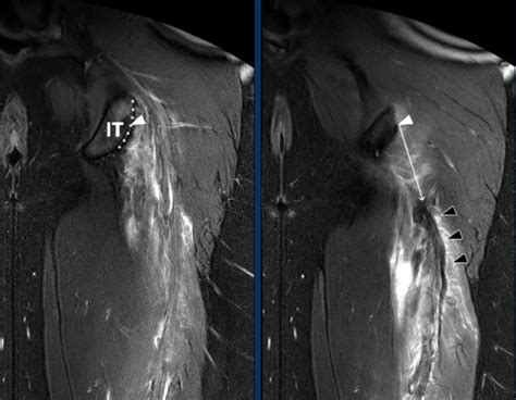 Medial Hamstring Reflex Test 的图像结果