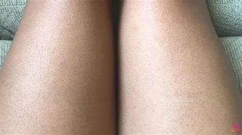 A dermatologist’s advice on strawberry legs - Galaxus
