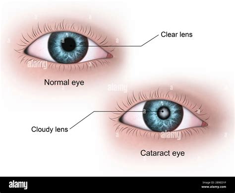 Image result for Normal Human Eye