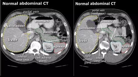 LIVER SEGMENT ANATOMY CT SCAN | PPTX