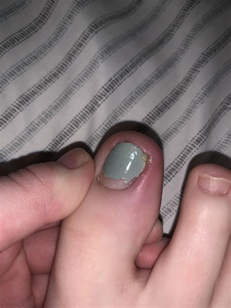 Full Toenail Extraction 的图像结果