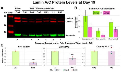 LMNA-Related Dilated Cardiomyopathy: Single-Cell Transcriptomics during Patient-Derived iPSC ...