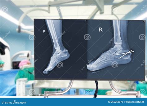 Calcaneus Fracture Anatomy With Broken Heel Bone Structure Outline Diagram Cartoon Vector ...