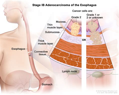 Esophageal Cancer Treatment (PDQ®) - NCI