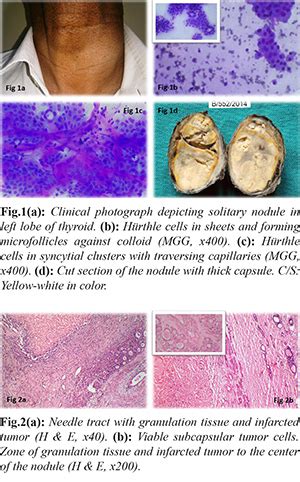 Infarction of Hürthle Cell Tumor of Thyroid Following Fine Needle ...
