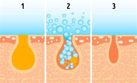 Salicylic Acid for Acne: Benefits, Side Effects & Safe Use