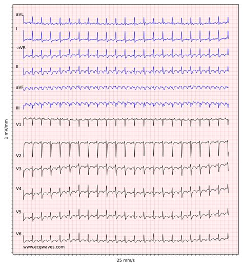 Atrial flutter: classification, causes, ECG diagnosis & management ...