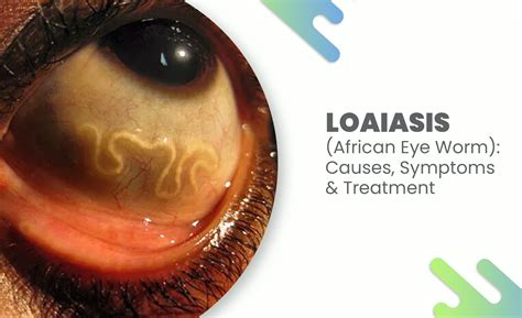 Loiasis (African Eye Worm): Causes, Symptoms & Treatment