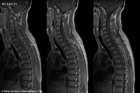 What Is A Lumbar Mri Without Contrast at Leon Hendricks blog