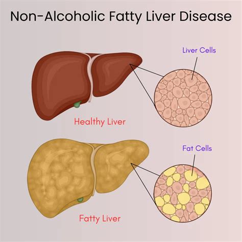Non-Alcoholic Fatty Liver Disease (NAFLD): Tests, Stages & Treatment - DiseaseFix