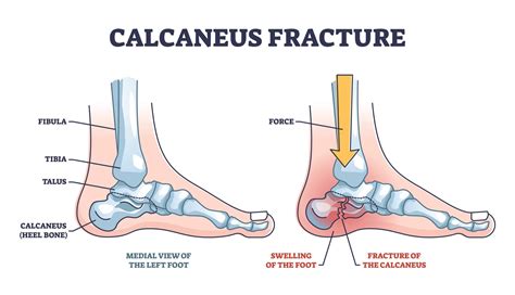 Calcaneus Fracture Swelling