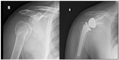The Evolution of Reverse Total Shoulder Arthroplasty and Its Current Use in the Treatment of ...